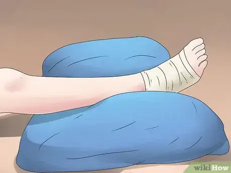 Imagen titulada Tape a High Ankle Sprain Step 13