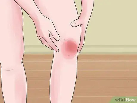Imagen titulada Tell if You Strained Your Knee Step 1