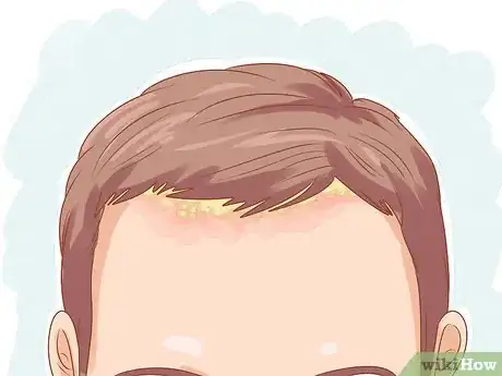 Imagen titulada Get Rid of Dandruff (Natural Methods) Step 12