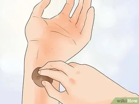 Imagen titulada Treat a Small Burn Step 16