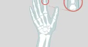 saber si un dedo está fracturado