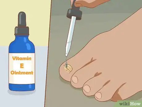 Imagen titulada Help a Toenail Grow Back Quickly Step 11