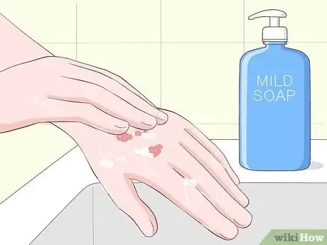 Imagen titulada Heal Scabies Scars Step 15