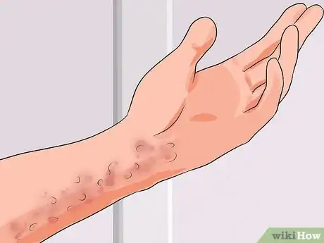 Imagen titulada Recognize and Treat Dengue Fever Step 5