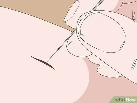 Imagen titulada Remove Glass from a Wound Step 4