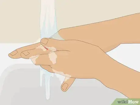 Imagen titulada Deal With the Pain of a Door Being Shut on Your Finger Step 9