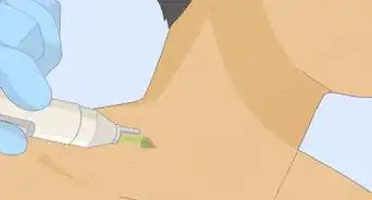 quitar los acrocordones de la piel