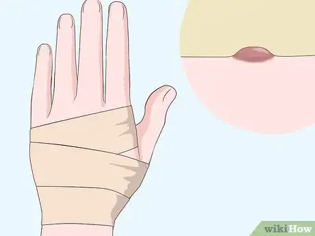 Imagen titulada Heal Scabies Scars Step 4