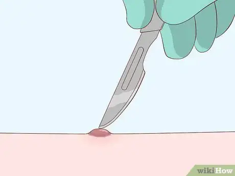 Imagen titulada Heal Scabies Scars Step 11