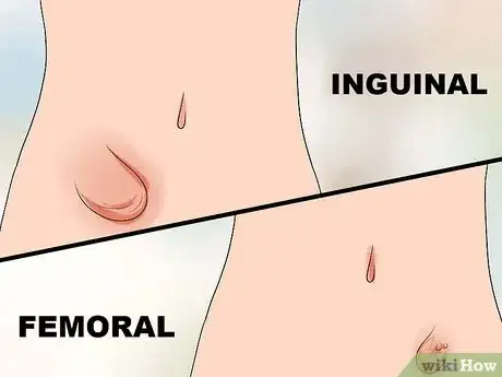Imagen titulada Push a Hernia Back in Step 10