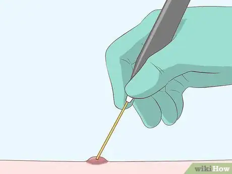 Imagen titulada Heal Scabies Scars Step 10