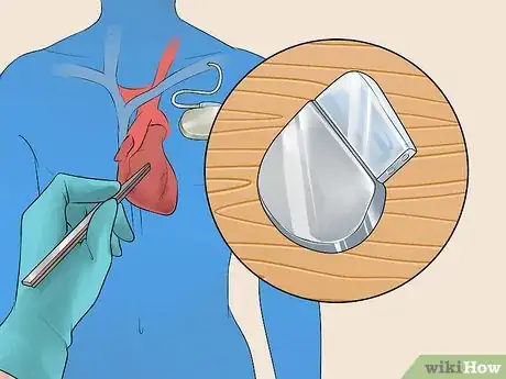 Imagen titulada Treat Tachycardia Step 9