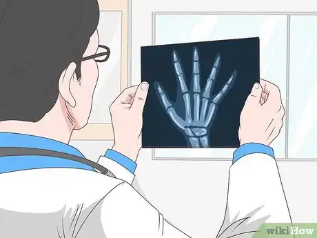 Imagen titulada Fix a Dislocated Finger Step 6