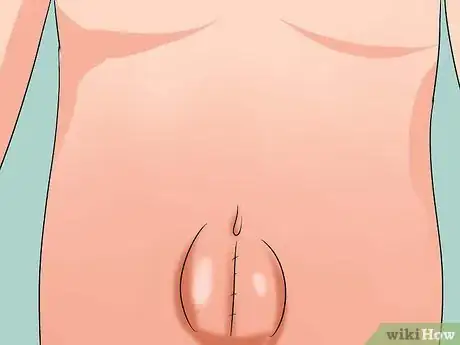 Imagen titulada Push a Hernia Back in Step 13