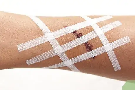 Imagen titulada Apply a Butterfly Bandage Step 7