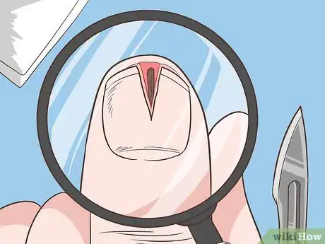 Imagen titulada Remove a Deep Splinter Step 17