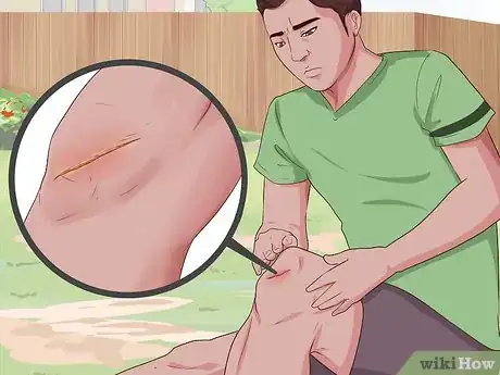 Imagen titulada Check a Wound for Infection Step 11