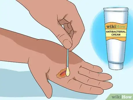 Imagen titulada Prevent Cellulitis Step 3