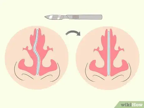 Imagen titulada Fix a Crooked Nose Step 5