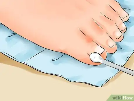 Imagen titulada Remove an Ingrown Toenail Step 7