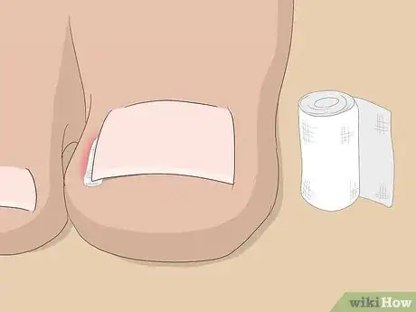 Imagen titulada Relieve Ingrown Toe Nail Pain Step 17