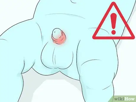 Imagen titulada Clean a Circumcision Step 11