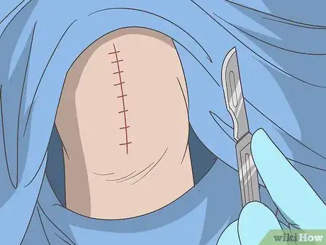 Imagen titulada Treat Crepitus Step 16