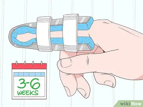 Imagen titulada Fix a Dislocated Finger Step 8