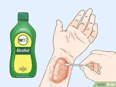 Image intitulée Get Rid of Poison Ivy Rashes Step 5