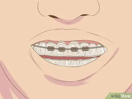 Image intitulée Make Fake Braces or a Fake Retainer Step 16