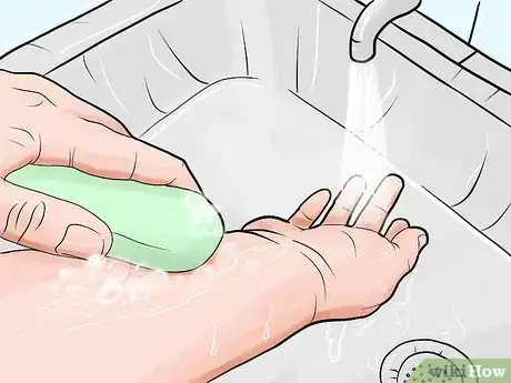 Image intitulée Heal Mosquito Bites Step 1