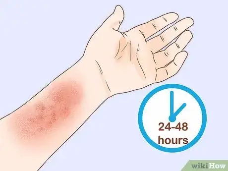 Image intitulée Get Rid of Poison Ivy Rashes Step 1