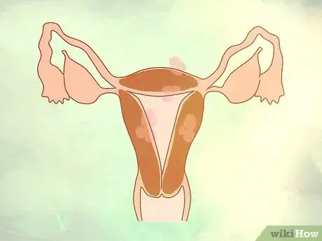 Image intitulée Decide if You Need a Hysterectomy Step 3