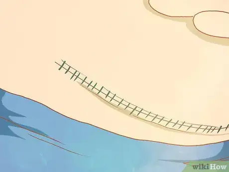Image intitulée Decide if You Need a Hysterectomy Step 2