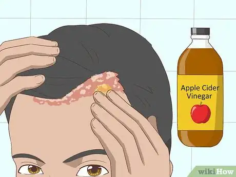 Image intitulée Treat Psoriasis Naturally Step 5