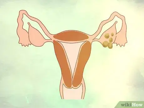 Image intitulée Decide if You Need a Hysterectomy Step 1