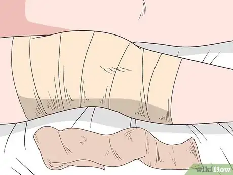 Image intitulée Reduce Swelling After Knee Surgery Step 5