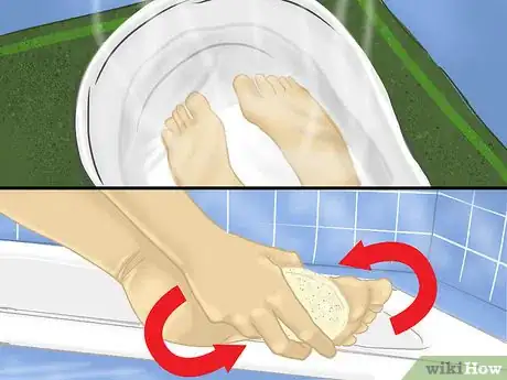 Image intitulée Remove Verrucas Step 7