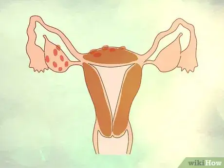 Image intitulée Decide if You Need a Hysterectomy Step 4
