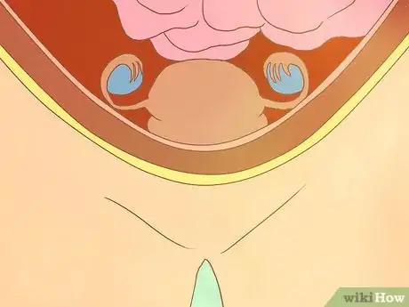 Image intitulée Decide if You Need a Hysterectomy Step 5