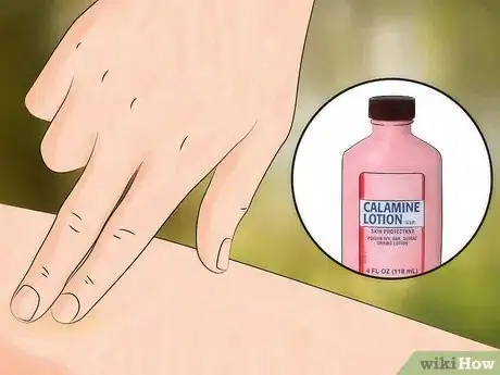 Image intitulée Get Rid of Bug Bites Step 3