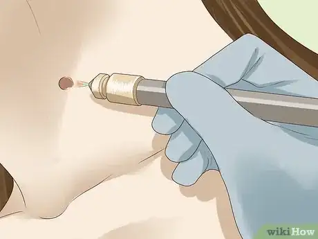 Image intitulée Get Rid of Skin Tags Step 4