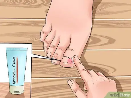 Image intitulée Avoid Ingrown Toenails Step 8