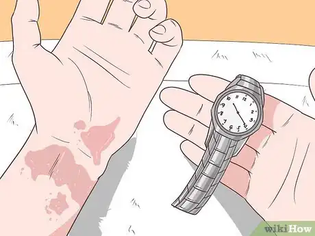 Image intitulée Treat Apple Cider Vinegar Burns Step 1