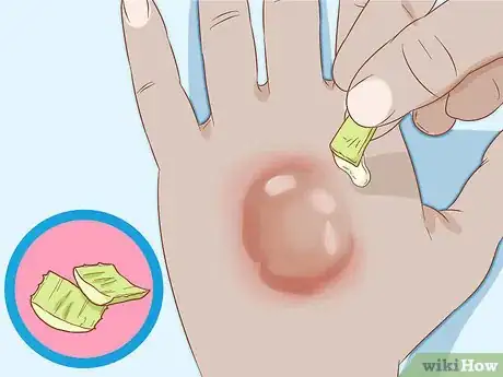 Image intitulée Get Rid of Poison Ivy Rashes Step 13