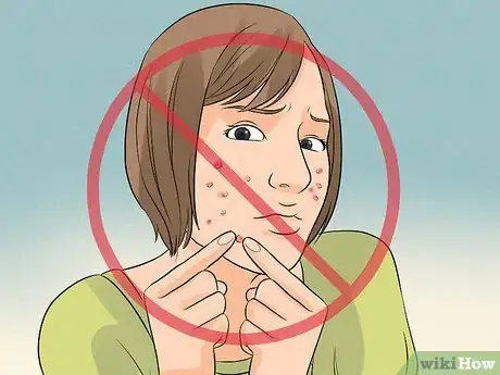 Image intitulée Deal With Pimples Step 13