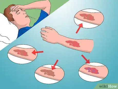 Image intitulée Treat Electrical Burns Step 10