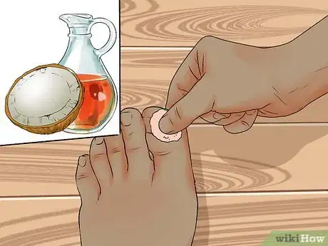 Image intitulée Avoid Ingrown Toenails Step 10