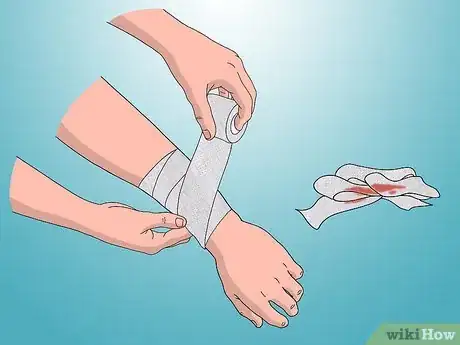 Image intitulée Treat Electrical Burns Step 11