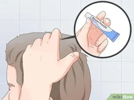 Image intitulée Treat Scalp Pimples Step 1